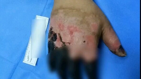 Man falls asleep drunk on the roadside; five fingers freeze to death and are amputated.