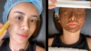 PRP CẤY MÁU TỰ THÂN ĐIỀU TRỊ DA _ RIN NGUYEN _ SKINCARE TIPS