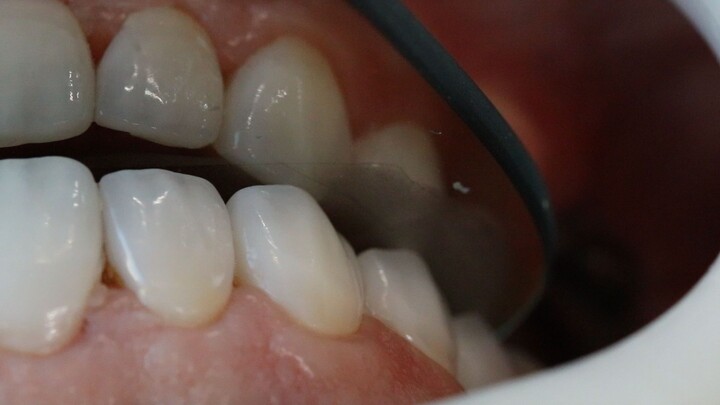 lente dental