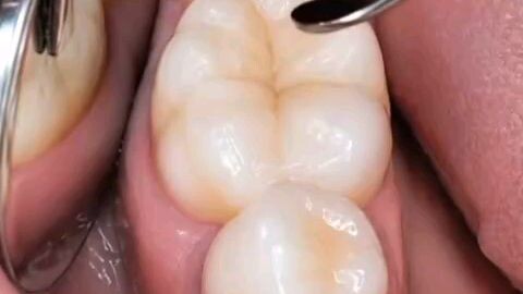 Dentistry #TeethCare #AIAnimatio#DentalRestoration #TeethTransformation #Dentist #DentalCare #Health