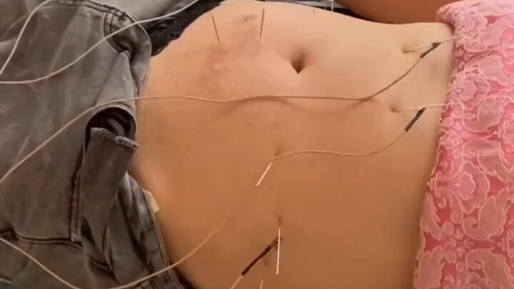 Acupuncture for the Stomach