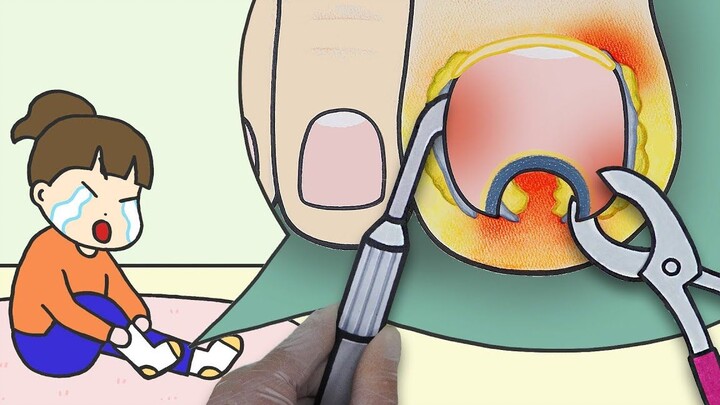 [Stop-motion animation] 😵Immersive treatment of paronychia, care for ingrown toenails that look pain