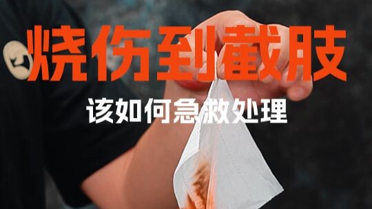 Dari luka bakar hingga amputasi, bagaimana cara melakukan pertolongan pertama yang sederhana?