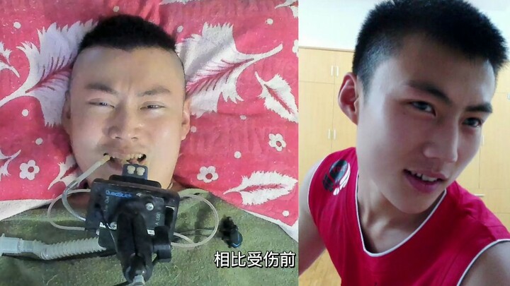 حلقت شعري، أيهما أجمل قبل الإصابة أم بعدها؟