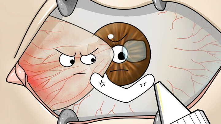 [Clip·MAD·Dubbing] Pterygium Excision! Check how the surgery works