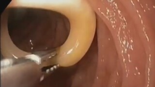 Removal of roundworms from the duodenum