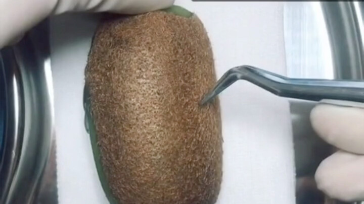 The Past and Present of Hair Loss!