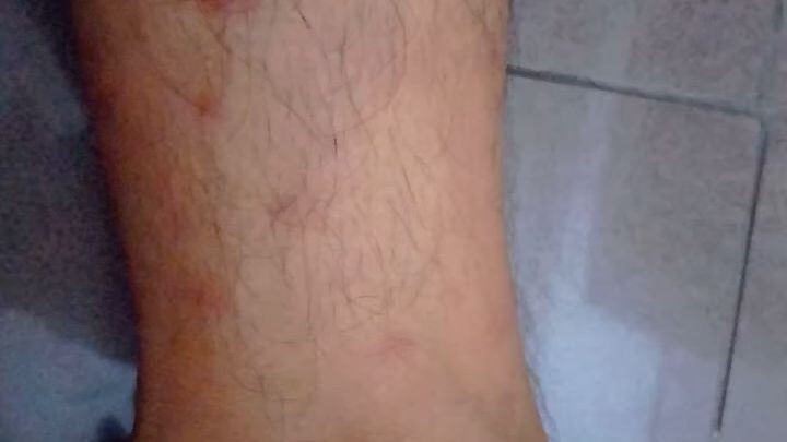 Cara Bedakan Biduran Dan Alergi Dengan Mudah