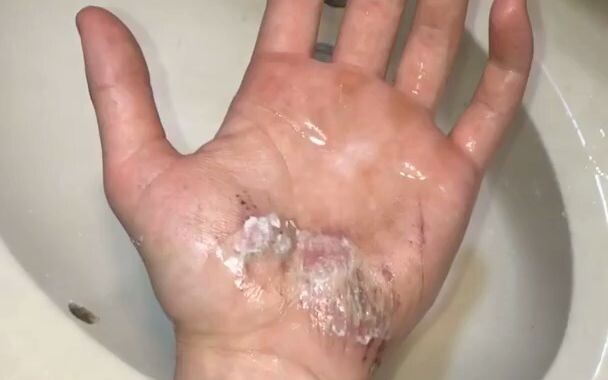 Disinfecting a Hand Wound with Hydrogen Peroxide Is So Satisfying!
