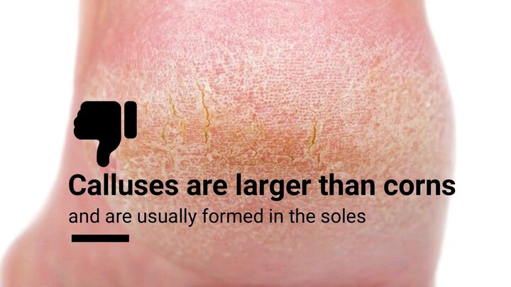 DIY Natural Foot Corn Removal