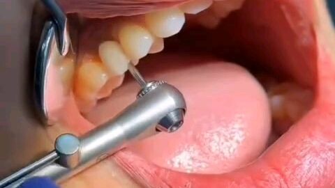Dental Implant