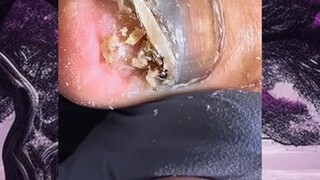 toenail ingrown removal