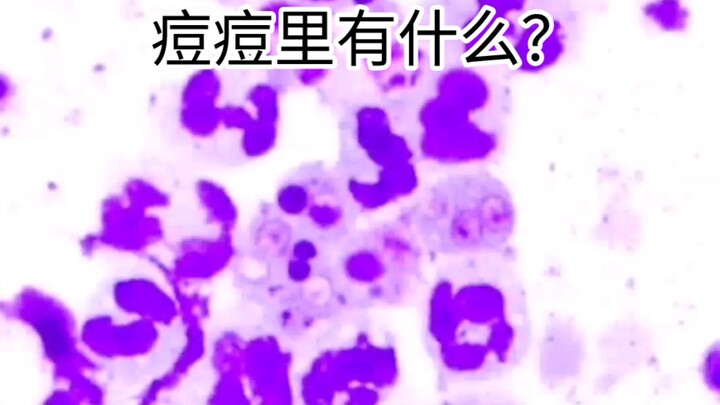 What’s Inside Your Pimples?