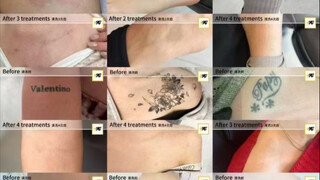 If you need tattoo removal, just contact me.