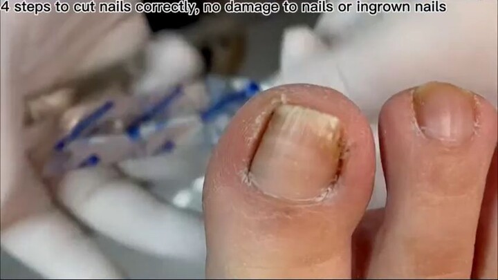 Normal toenails can also hide dirt_R