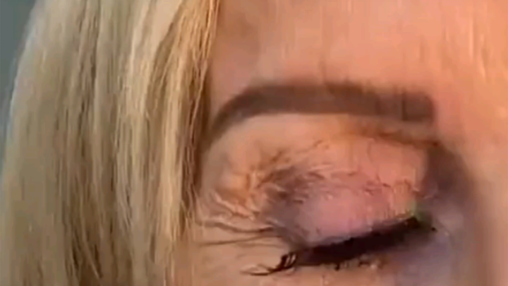An外籍 aunt had 23 pairs of contact lenses removed from her eyes! A kind doctor helped take them out, 