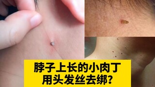 [Science] Don't bother that little flesh tag on your neck—be careful, or it might grow more!
