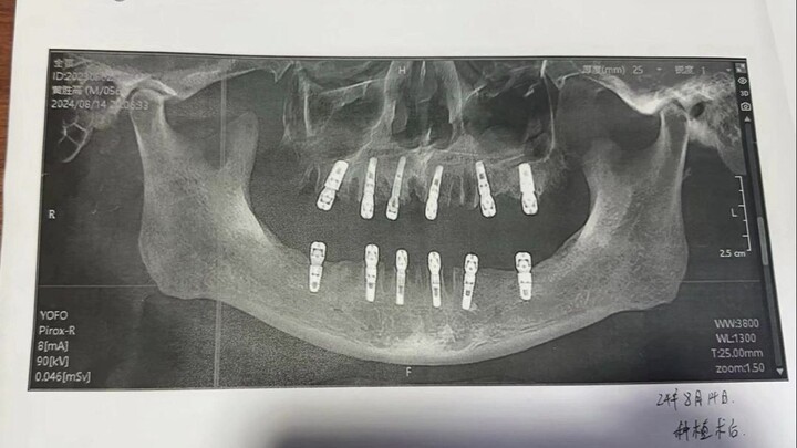 Died after having 23 teeth extracted in one session