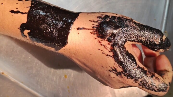 حروق الإسفلت: مشاركة تجربة شخصية