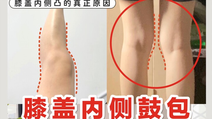 3 Steps to Fix the Bulge on the Inside of Your Knee | The Truth Behind That Bump on Your Inner Knee