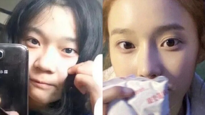 Kim Min-jeong: Side Effects of Eye Surgery and Brow Lift (Part 1)