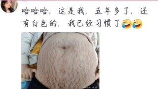 一宝妈晒出妊娠纹引发评论区众多宝妈晒图共情，有人后悔难过，有人早已习惯，有人心满意足