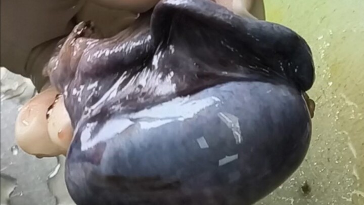 Xoắn tinh hoàn dẫn đến hoại tử! Triệu chứng điển hình của xoắn tinh hoàn bao gồm: sưng tinh hoàn, đa