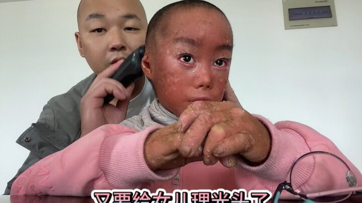 Mông Mông ơi, đợi đầu con hết ngứa rồi bố sẽ để tóc cho con tết bím nhé.