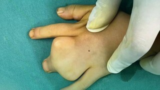 Little girl has complex fused fingers; mom says: You can't tell now when the child goes out.