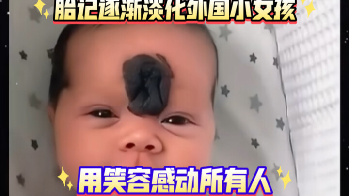 A little girl abroad was born with a very severe birthmark on her face. Over time, after several rou