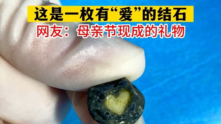 Đây là một viên sỏi thận mang “tình yêu”! Quà tặng Ngày của Mẹ đã sẵn sàng.