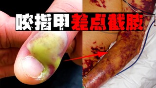 [Cắn Chết Người] Tôi cắn móng tay và bị nhiễm trùng máu. Tay tôi bị loét và đầy vết thâm. Tôi suýt c