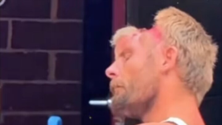 Đây là bệnh gì vậy? Người đàn ông thiếu hộp sọ trên đường phố Mỹ