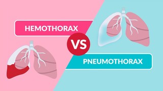 Hemothorax vs. Pneumothorax