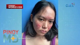 Ano ang sanhi sa pagkakaroon ng cystic acne? | Pinoy MD
