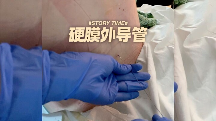 Ống thông ngoài màng cứng dùng cho sinh không đau rốt cuộc dài bao nhiêu