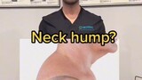 neck hump hack