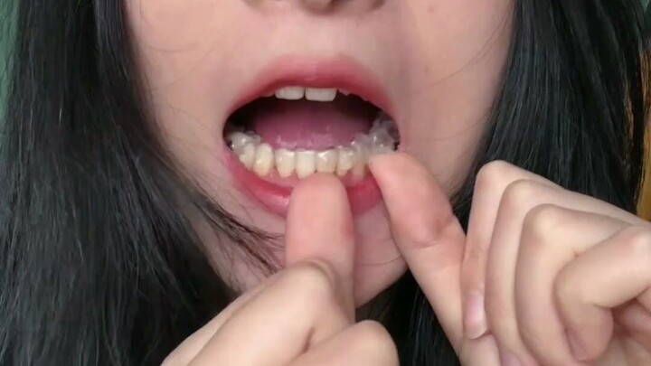 Trải nghiệm chân thực - Tháo niềng răng trong suốt: Nước bọt chảy thành sợi là hiện tượng bình thườn