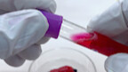A lab worker has been accidentally infected. Several vital signs are currently abnormal; I may lose 