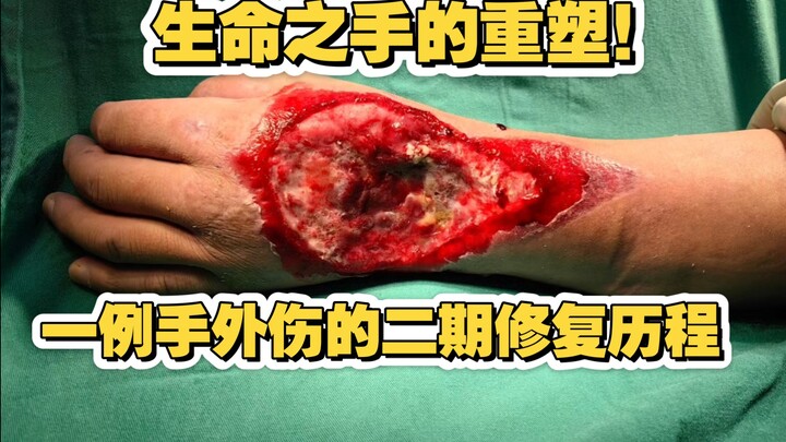 Pemulihan Tangan Kehidupan – Tahapan Perbaikan Sekunder pada Trauma Tangan