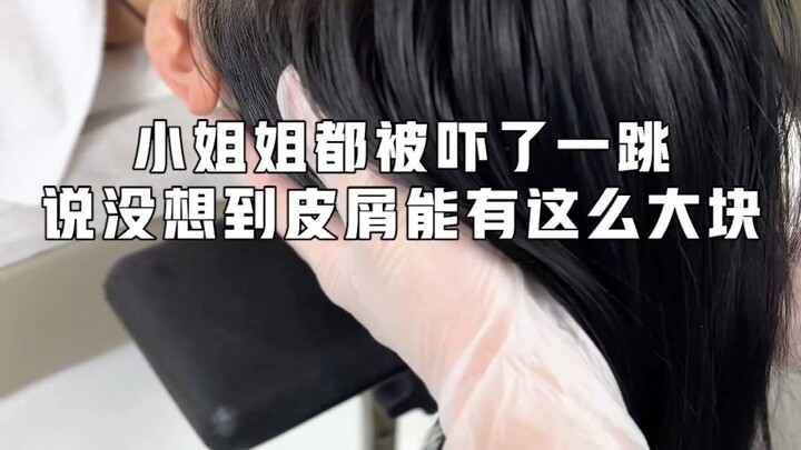สาวน้อยถึงกับสะดุ้งตกใจ บอกว่าไม่คิดเลยว่าสะเก็ดผิวหนังจะหลุดออกมาเป็นชิ้นใหญ่ขนาดนี้