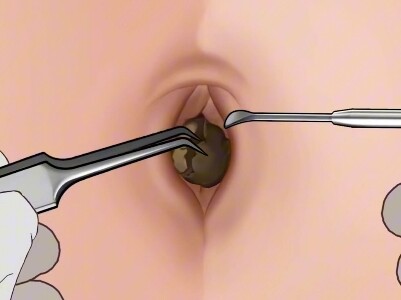 Foreign object removal, decompression satisfaction