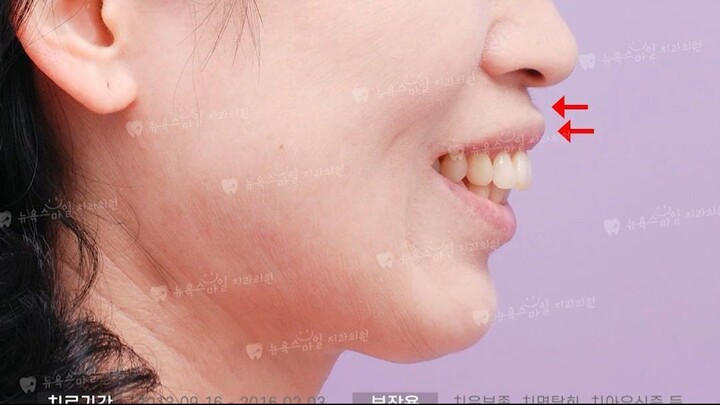 釜山正畸：纽约微笑牙科带您了解“牙龈突出与无颌”的 S&S 矫正 😉