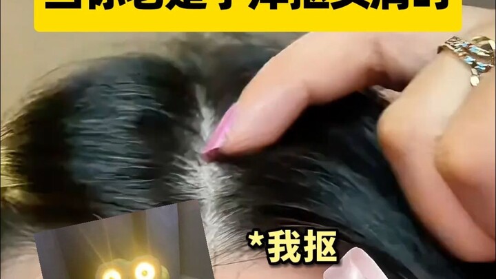 คุณก็เป็นแบบนี้ใช่ไหม ยิ่งใหญ่ยิ่งตื่นเต้นเหรอ? นี่ไม่ใช่รังแคธรรมดาๆนะ! อย่าไปแกะเล่นล่ะ