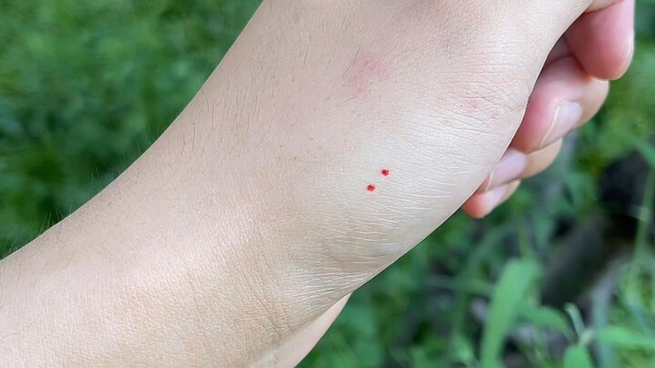 I Got Bitten by a Snake!