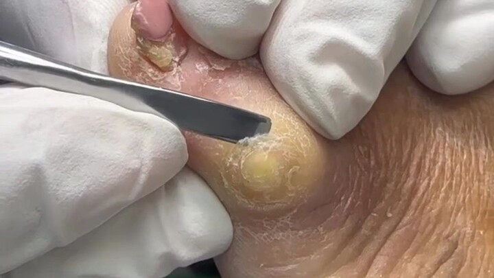 quiropie
