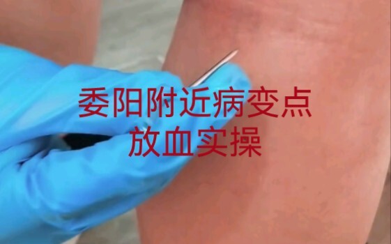 Pricking for blood at the affected point near Weiyang