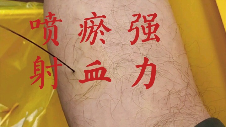 Near the Yinlingquan point, when pricked for bloodletting, stagnant blood gushed out in jets!