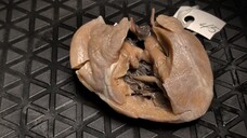 双出口右心室（DORV）伴双连通室间隔缺损及房间隔缺损 | Double Outlet Right Ventricle, Doubly Committed VSD & ASD