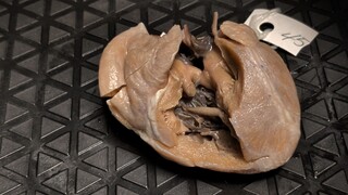 双出口右心室（DORV）伴双连通室间隔缺损及房间隔缺损 | Double Outlet Right Ventricle, Doubly Committed VSD & ASD